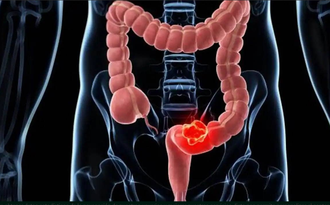 Estados Unidos aprueba un nuevo análisis de sangre para detectar el cáncer de colon