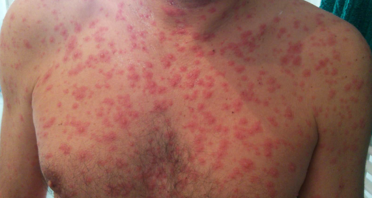 Brote de varicela obliga a colegio del Distrito Nacional a poner en cuarentena a alumnos de un grado