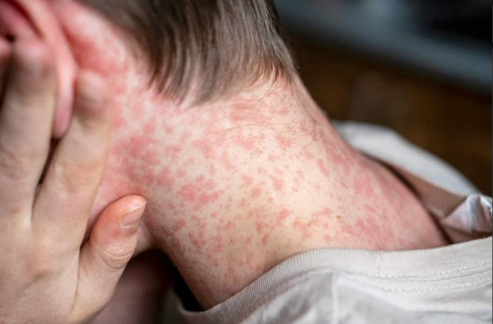 Texanos aceleran vacunación tras muerte de niño con sarampión en Texas