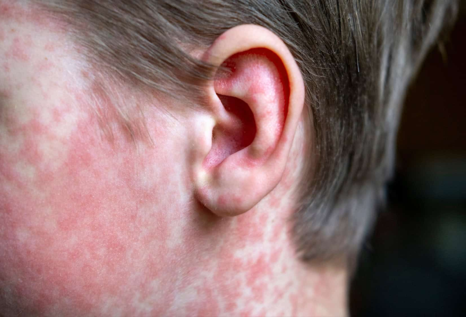 Autoridades sanitarias en Texas advierten que el brote de sarampión podría durar meses